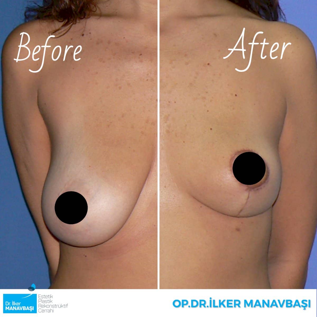 Case 21350 - breast lift