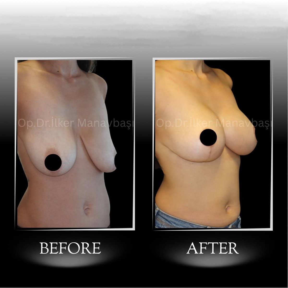 Case 21351 - breast implants with lift