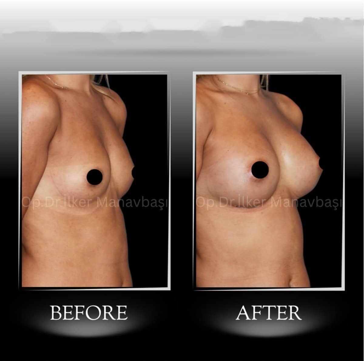Case 21352 - breast augmentation