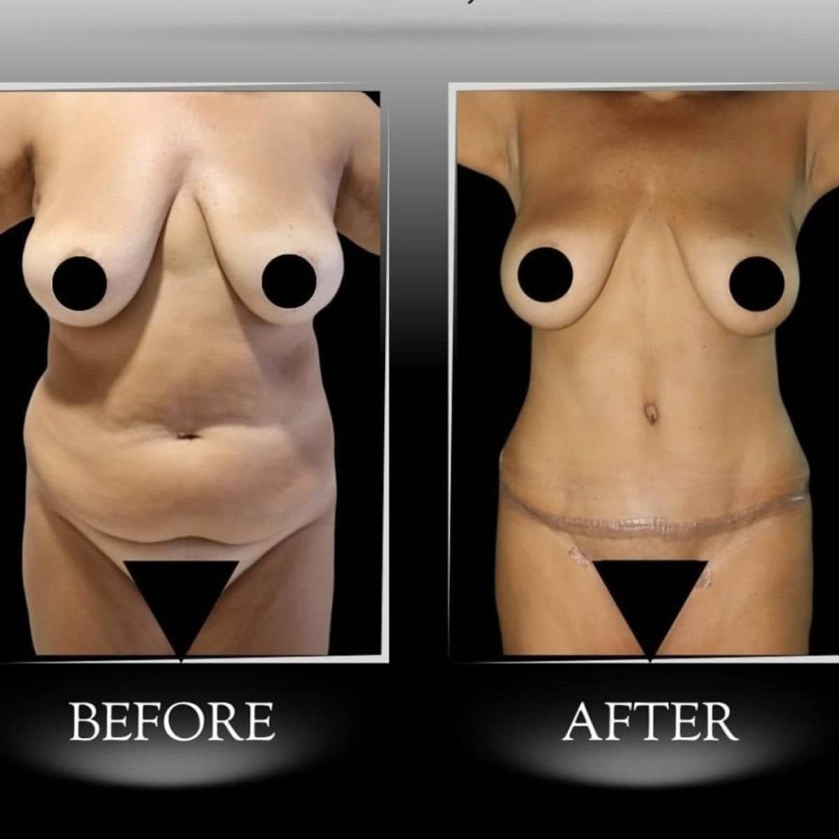 Case 21353 - Vaser 3 areas plus tummy tuck