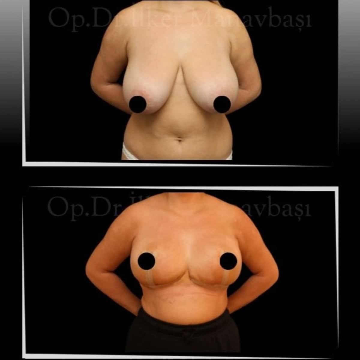 Case 21355 - breast reduction