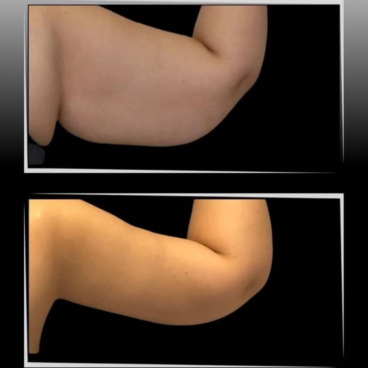 Case 21356 - arm lift