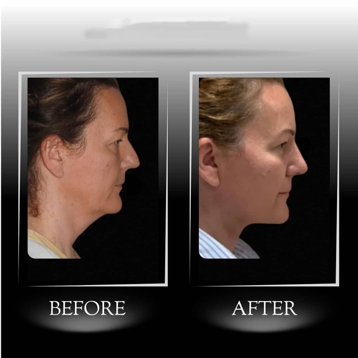 Case 21357 - Hyaluronic Acid Threads Lifting