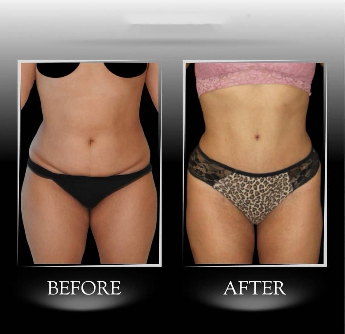 Case 21358 - tummy tuck