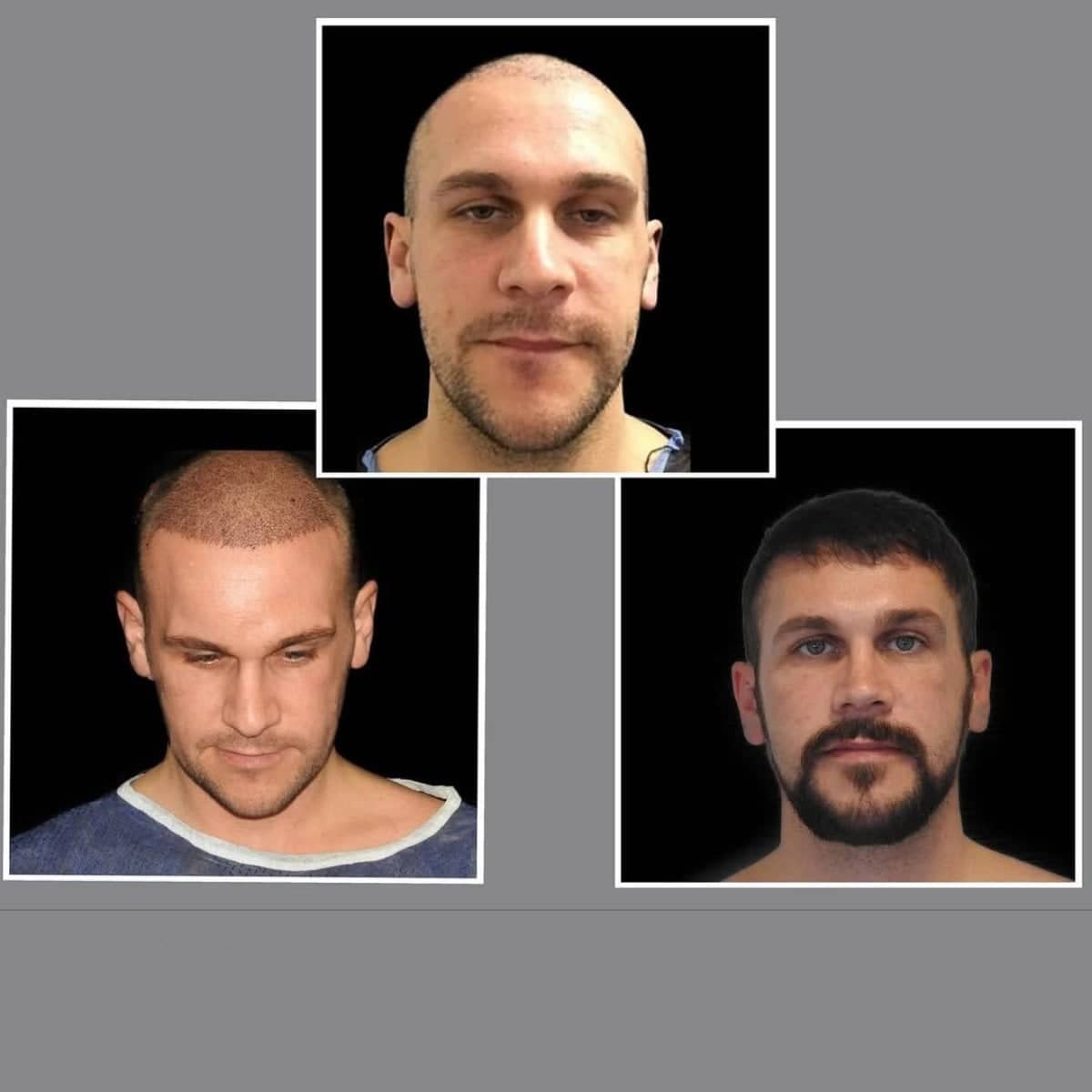 Case 21360 - FUE hair transplant