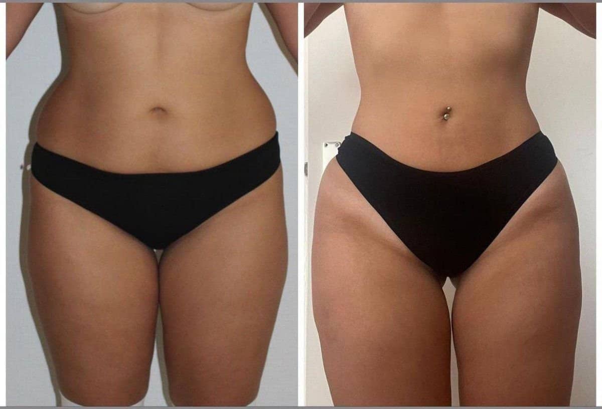 Case 21363 - Vaser 3 Areas plus tummy tuck