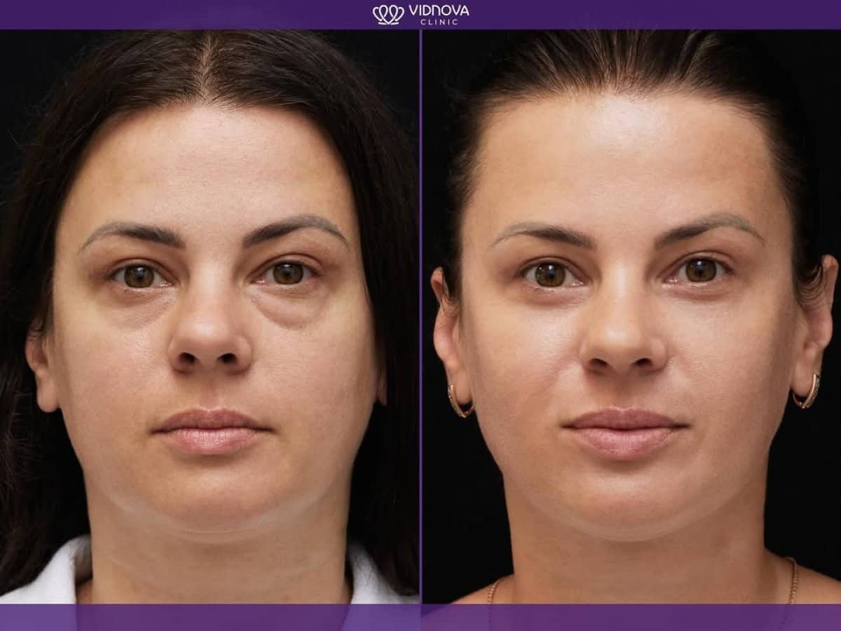 Case 21366 - blepharoplasty