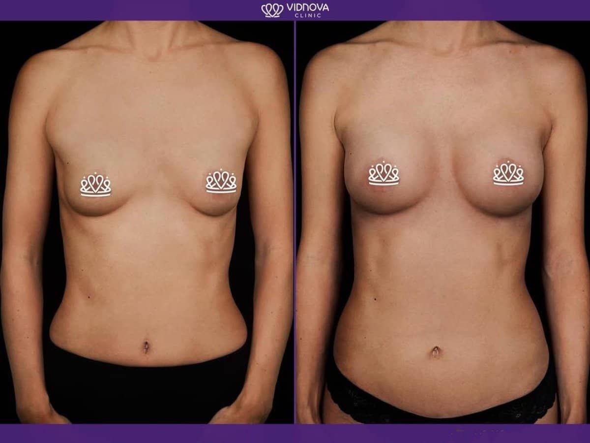 Case 21368 - mammoplasty