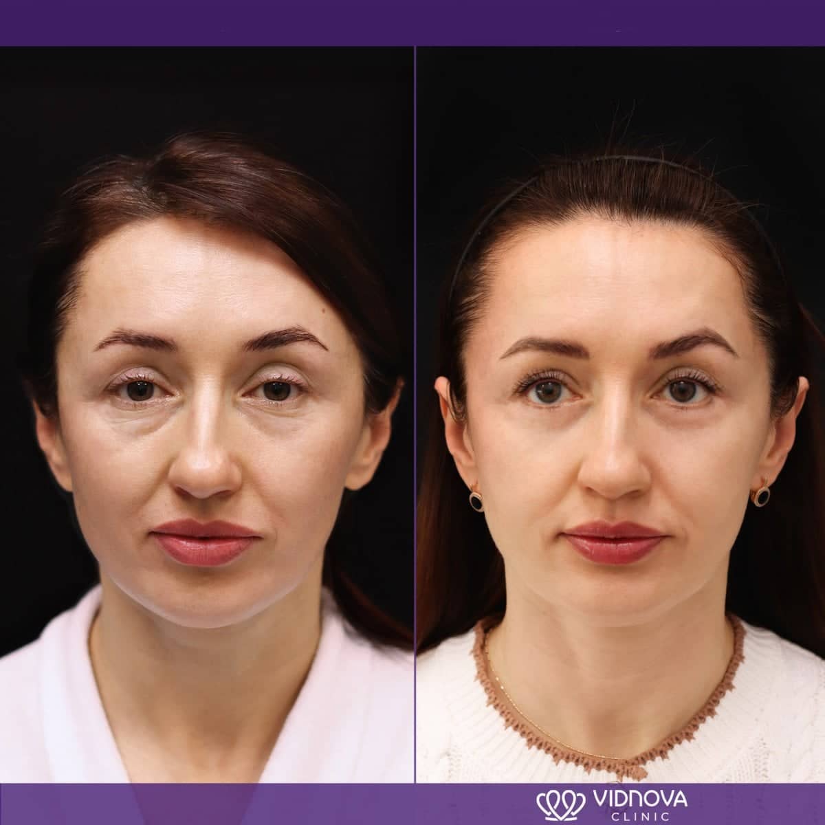 Case 21369 - blepharoplasty