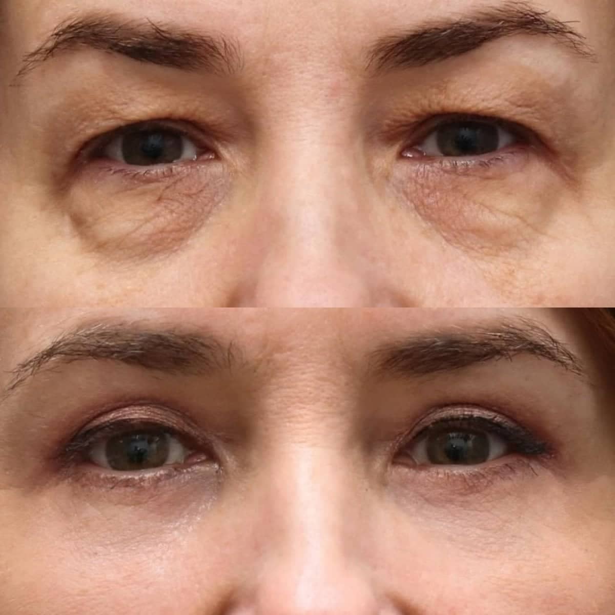 Case 21370 - blepharoplasty