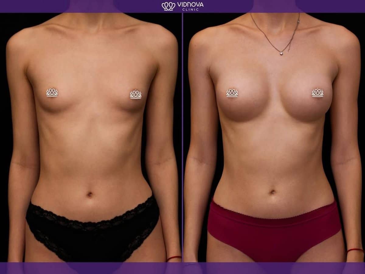 Case 21371 - mammoplasty