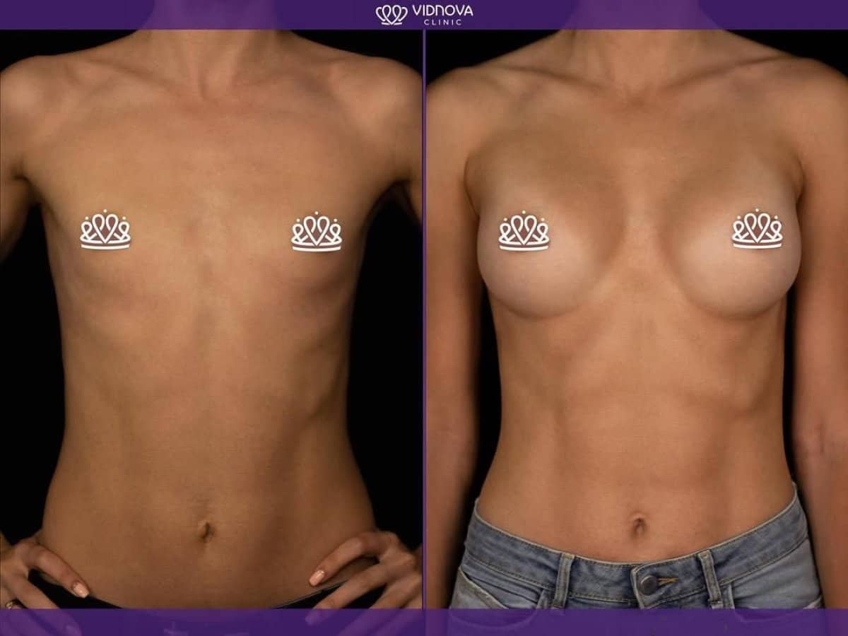 Case 21373 - mammoplasty