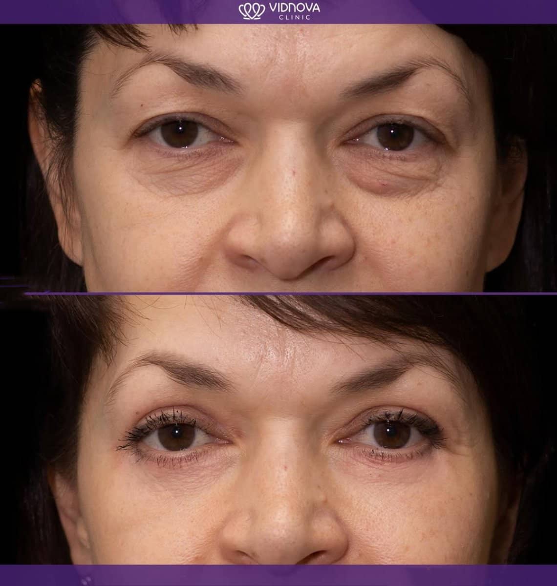 Case 21377 - blepharoplasty