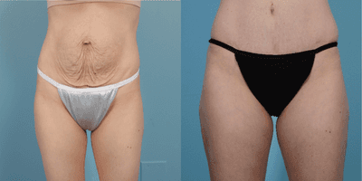 Case 2179 - 35-44 year old woman treated with Tummy Tuck