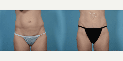 Case 2189 - 25-34 year old woman treated with Tummy Tuck