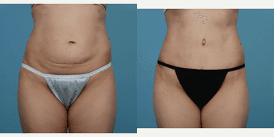 Case 2220 - 35-44 year old woman treated with Tummy Tuck