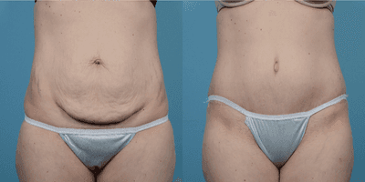 Case 2279 - 35-44 year old woman treated with Tummy Tuck