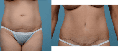 Case 2280 - 35-44 year old woman treated with Tummy Tuck