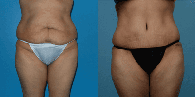 Case 2283 - 35-44 year old woman treated with Tummy Tuck