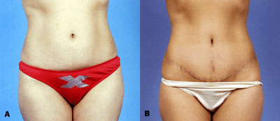 Case 2459 - Abdominoplasty