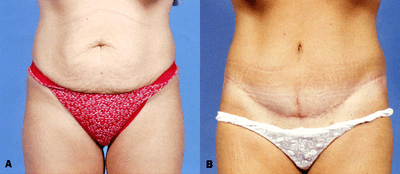 Case 2460 - Abdominoplasty