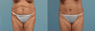 Case 2467 - Abdominoplasty