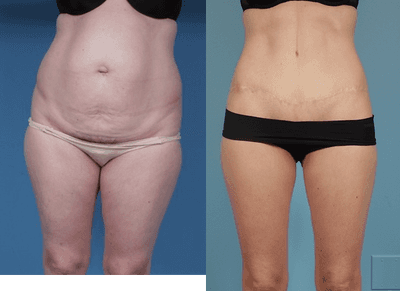 Case 2468 - Tummy Tuck