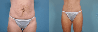 Case 2473 - Tummy Tuck (Abdominoplasty)