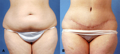 Case 2474 - Tummy Tuck (Abdominoplasty)