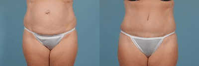 Case 2475 - Tummy Tuck (Abdominoplasty)