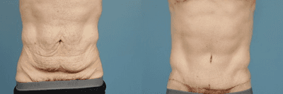 Case 2476 - Tummy Tuck (Abdominoplasty)