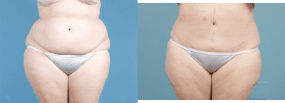 Case 2481 - Tummy Tuck