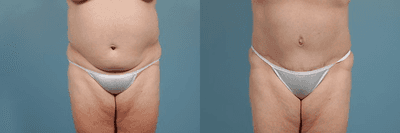 Case 2482 - Tummy Tuck