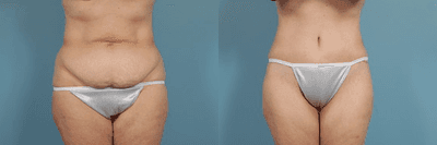 Case 2484 - Abdominoplasty Patient