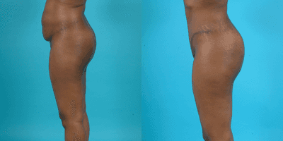 Case 2505 - abdominoplasty