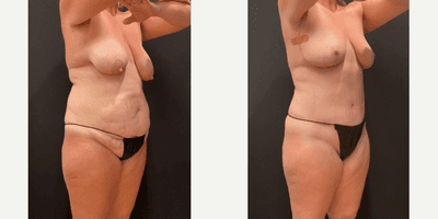 Case 2619 - 35-44 year old woman treated with Mommy Makeover, Breast Lift, Tummy Tuck