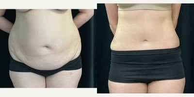 Case 3085 - 35-44 year old woman treated with Tummy Tuck, Liposuction
