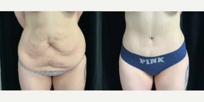 Case 3125 - 18-24 year old woman treated with Tummy Tuck, Liposuction
