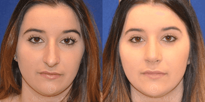 Case 3195 - Woman treated with Rhinoplasty