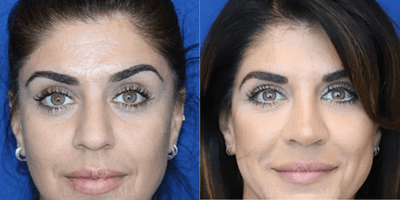 Case 3196 - Woman treated with Rhinoplasty