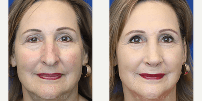 Case 3209 - Woman treated with Rhinoplasty