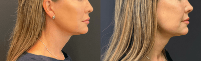Case 3218 - Woman treated with Rhinoplasty