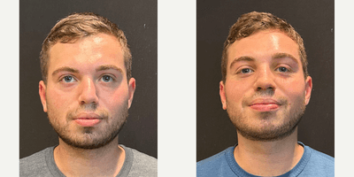 Case 3224 - Man treated with Rhinoplasty
