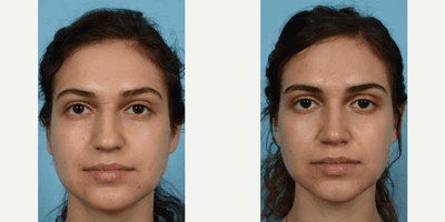 Case 3236 - Woman treated with Rhinoplasty
