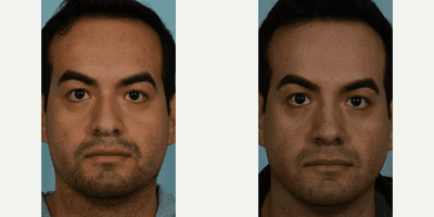 Case 3237 - Man treated with Rhinoplasty
