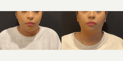 Case 3260 - Woman treated with Rhinoplasty