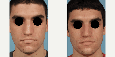 Case 3280 - Man treated with Rhinoplasty