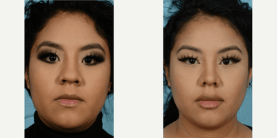 Case 3386 - Woman treated with Rhinoplasty