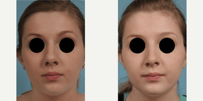 Case 3387 - Woman treated with Rhinoplasty