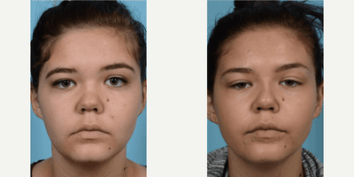 Case 3392 - Woman treated with Rhinoplasty